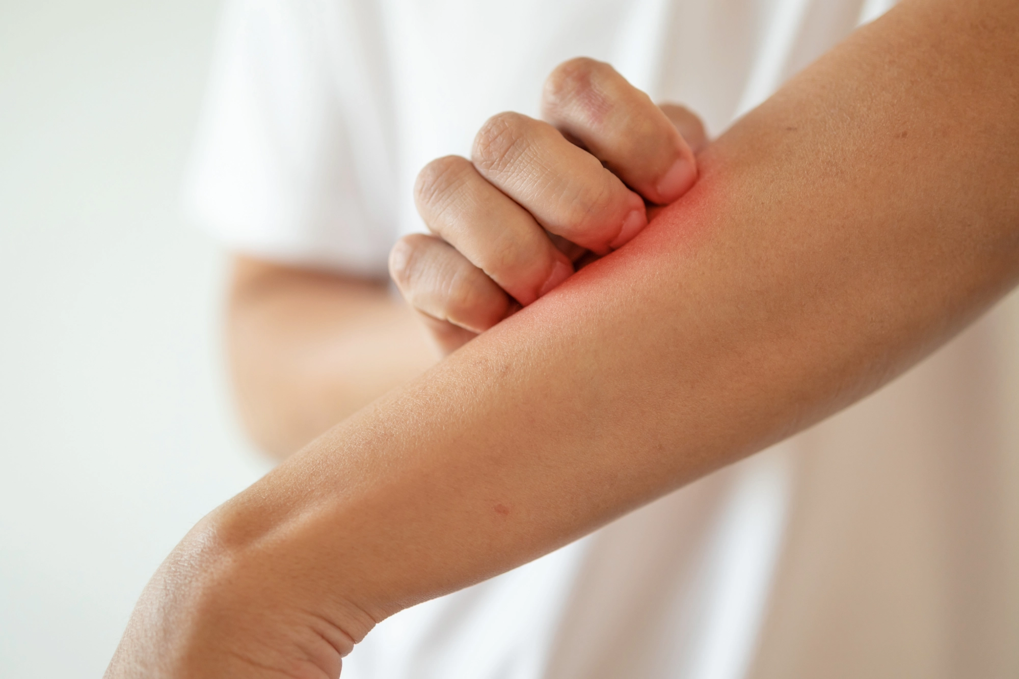 Close-up of a person scratching a red, irritated rash on their forearm, showing signs of skin irritation or allergic reaction.